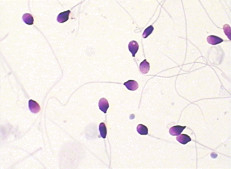 Morfologia do esperma BRED-015 que mancha o método de Kit Diff Quik Rapid Staining